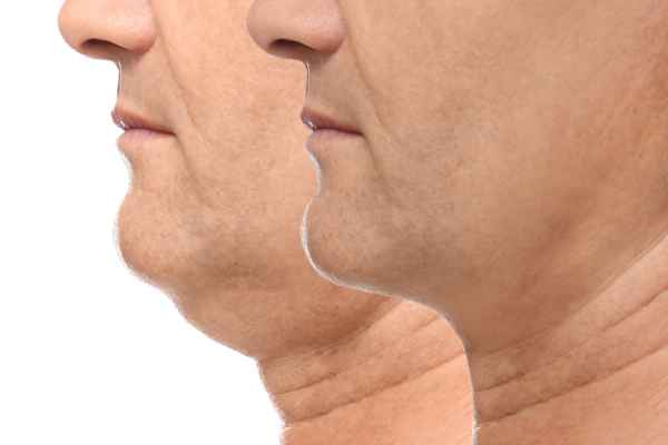 HIFU - Breakthrough in Anti - ageing 2 hifu results Rushden