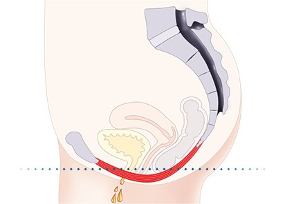 Pelvic-Floor Muscle Repair 5 Pelvic floor muscles Rushden