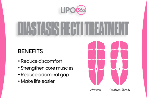 Revolutionising Muscle Repair: The Power of LIPO360 Body Sculpt Post-Injury 5 diastasis recti treatment Rushden