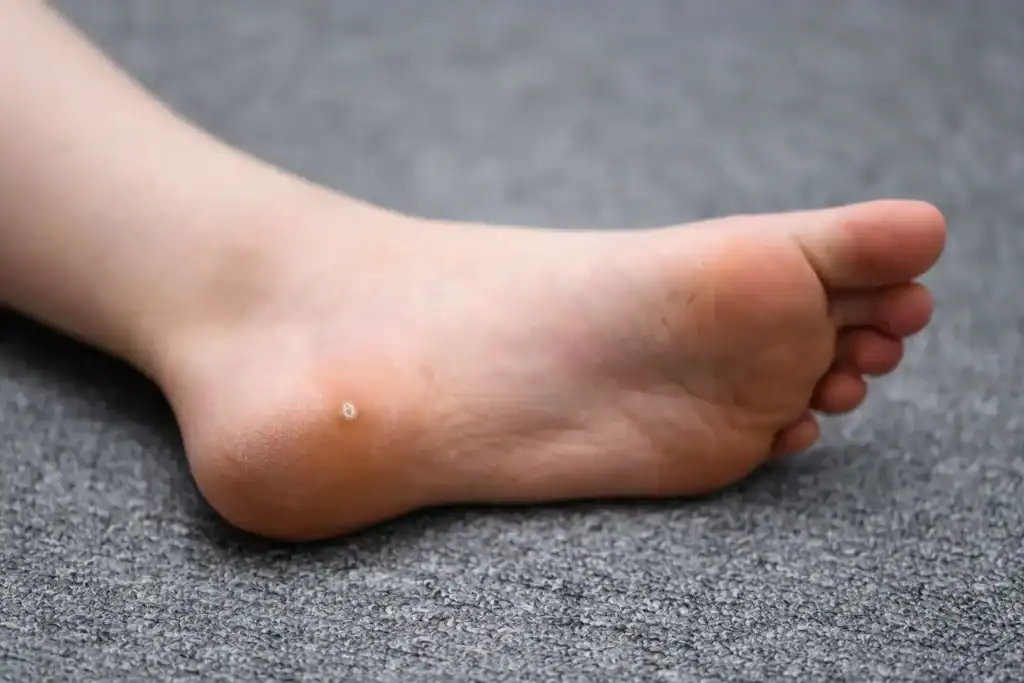 Cryotherapy For Warts And Also Verrucas 2 Image of verruca on the bottom of the foot that able to be treated with Cryotherapy Rushden