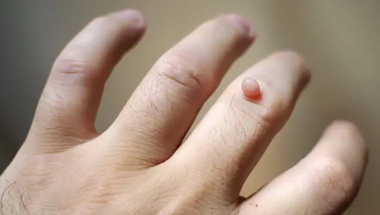 Cryotherapy For Warts And Also Verrucas 1 Image of blemish that Cryotherapy Rushden can remove with Lipo 360.