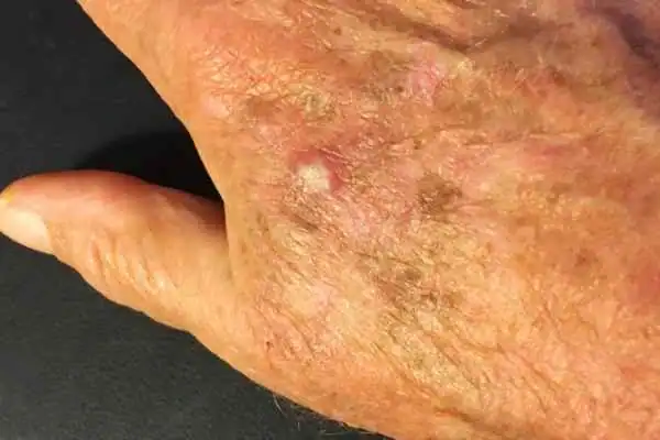 Cryopen For Actinic Keratoses 1 Image of Actinic keratoses Rushden on a person hand