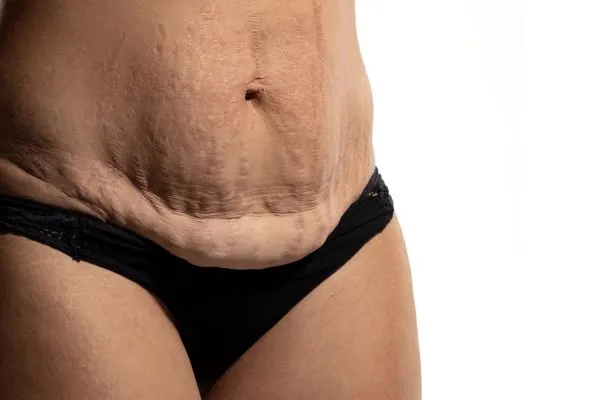 The Science of Skin Tightening 1 The science behind skin tightening Rushden picture of a woman's sagging skin on the stomach